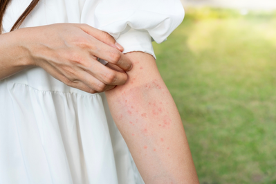 woman scratching heat rash on arm